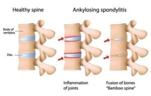 Ankylosing Spondilities Arthritis