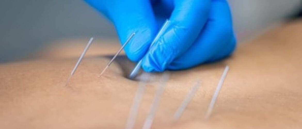 Managing Pain with Dry Needling