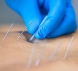 Managing Pain with Dry Needling